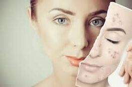 Botox vervangen