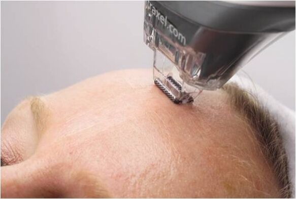 peelingprocedure voor gezichtshuidverjonging